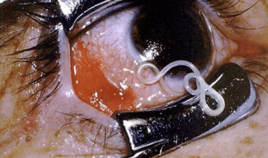 Soorten parasieten in het menselijk lichaam